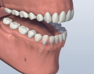 dentures3